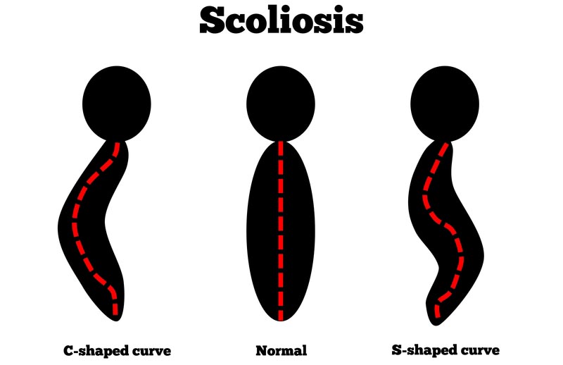 Brooklyn, NY scoliosis treatment